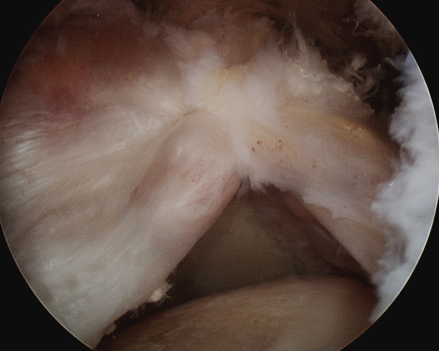 Massive Cuff Tear Partial Repair 2